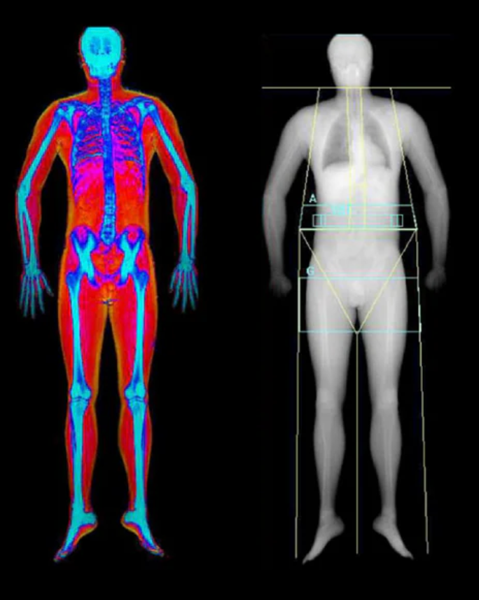 An example of a DEXA body composition scan